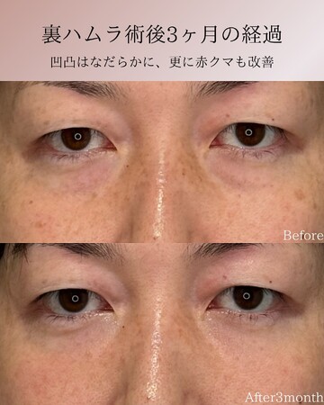 KNOT CLINIC AOYAMAの目元・クマ・眉下・涙袋整形の症例写真