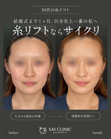 SAI CLINIC （サイクリニック）のリフトアップの症例写真