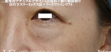 静岡美容外科橋本クリニックの二重の症例写真[ビフォー]