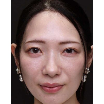 脂肪を活かす裏ハムラ法で段差のある目元を改善の症例写真[アフター]