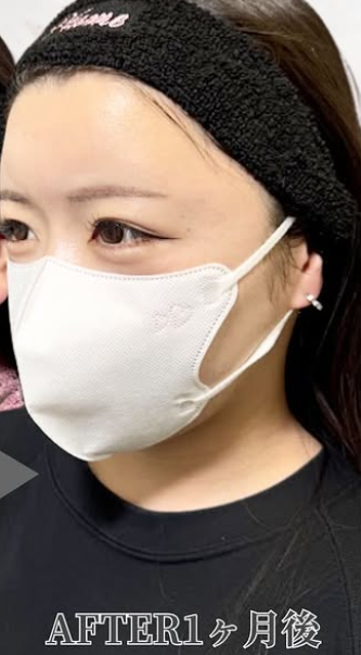 Plume Clinicの症例写真[アフター]