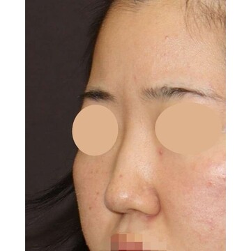 聖心美容クリニックの鼻の症例写真[ビフォー]