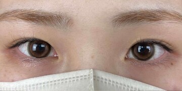AI Beauty Clinicの二重の症例写真[ビフォー]
