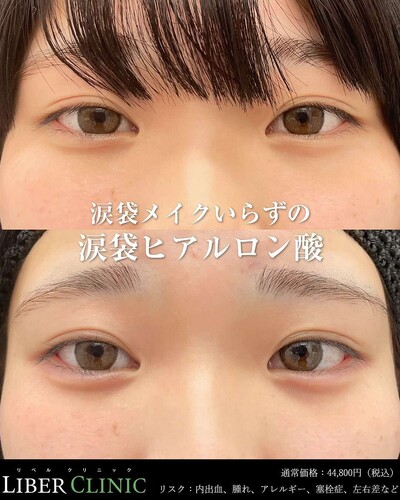 涙袋ヒアルロン酸💉の症例写真