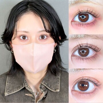 アリエル美容クリニック 大宮院の二重の症例写真