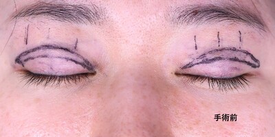 30代　ハム目修正（全切開法）　眠たそうに見える目を改善の症例写真[ビフォー]