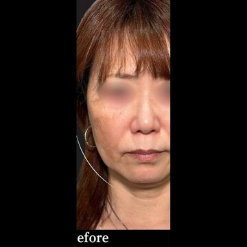PRISM Beauty Clinicのリフトアップの症例写真[ビフォー]