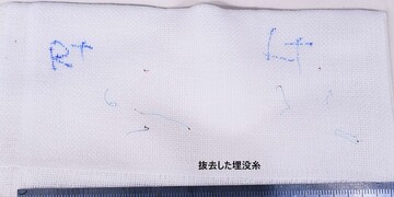 医療法人秀晄会 心斎橋コムロ美容外科クリニックの目・二重整形の症例写真[ビフォー]