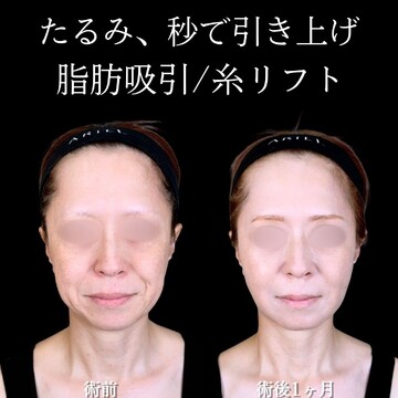 アリエル美容クリニック 大宮院の脂肪吸引の症例写真