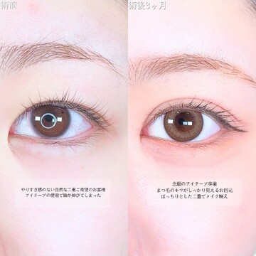 アリエル美容クリニック 大宮院の目・二重整形の症例写真