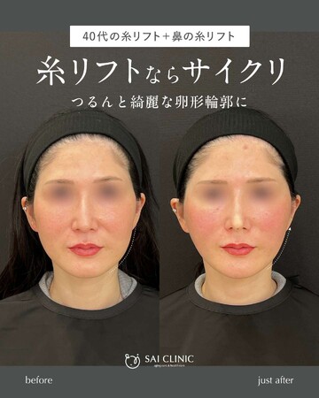 SAI CLINIC （サイクリニック）のリフトアップの症例写真
