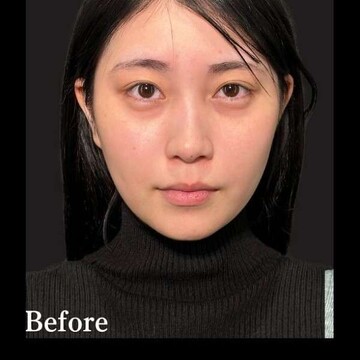 PRISM Beauty Clinicのリフトアップの症例写真[ビフォー]