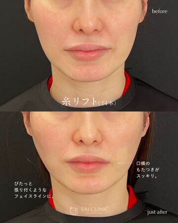 SAI CLINIC （サイクリニック）のリフトアップの症例写真