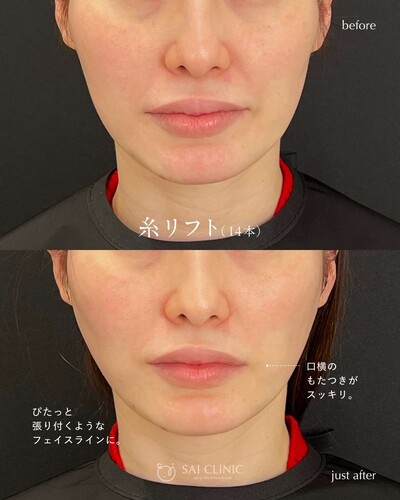 糸リフト（SAI LIFT STANDARD）14本の症例写真