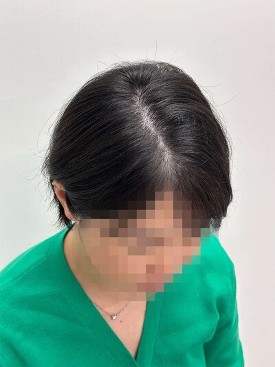 ヘアアートメイク｜40代｜2回の症例写真[アフター]