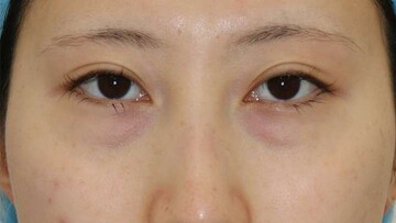 すなおクリニックの目元・クマ・眉下・涙袋整形の症例写真[ビフォー]