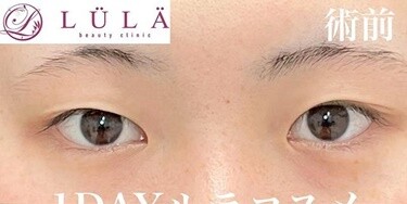 1DAYルラコスメの症例写真[ビフォー]