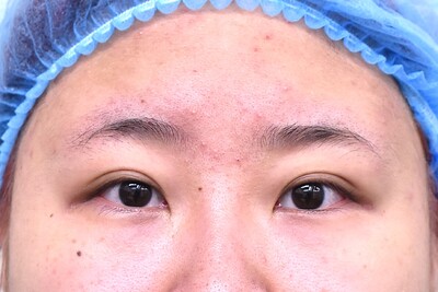 20代　女性　頬、目頭切開　W法　2㎜　当院モニターの症例写真