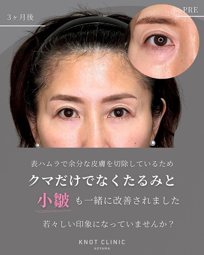 何歳からでも遅くないクマ治療【表ハムラ】の症例写真