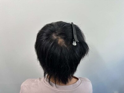 ヘアアートメイク｜20代｜1回の症例写真[アフター]