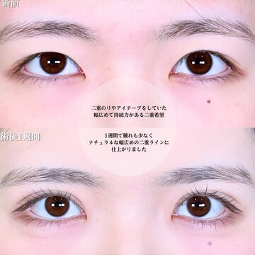 アリエル美容クリニック 大宮院の二重の症例写真