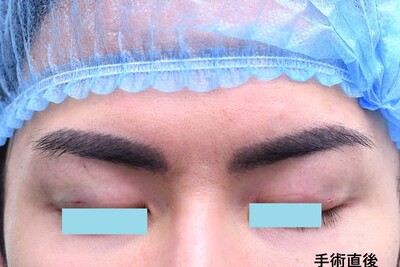 20代　男性　上まぶたの脂肪取り　（埋没法は行なわず）の症例写真[アフター]