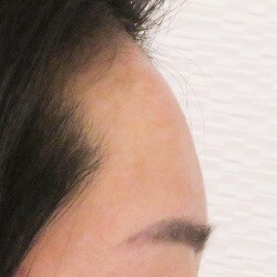 ヒアルロン酸注入でおでこを丸くする ヒアルロン酸注入 輪郭 顎 の症例 A Clinic エークリニック Cs 美容医療の口コミ広場