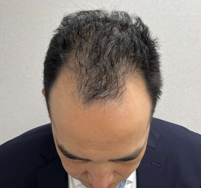 自毛植毛900グラフト｜50代｜3回の症例写真[ビフォー]