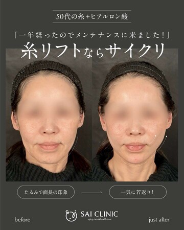 SAI CLINIC （サイクリニック）のリフトアップの症例写真