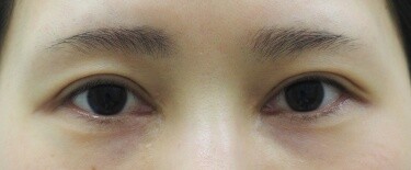 他院目頭切開術後修正の症例写真