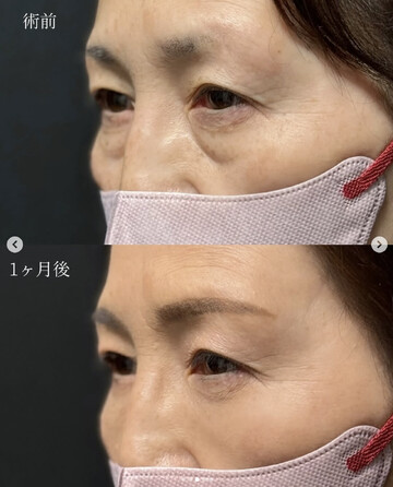 CLINIC Wの目元・クマ・眉下・涙袋整形の症例写真