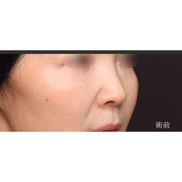 聖心美容クリニックの鼻の症例写真[ビフォー]