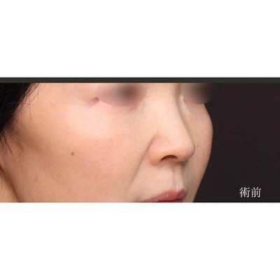 土手を温存した小鼻縮小（内外側法）（術後3ヶ月）の症例写真[ビフォー]