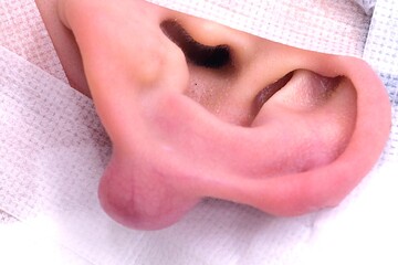 医療法人秀晄会 心斎橋コムロ美容外科クリニックの傷跡治療、ケロイドの症例写真