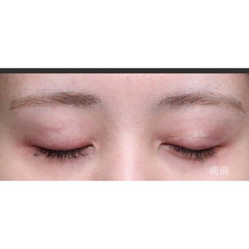 聖心美容クリニックの二重の症例写真[ビフォー]