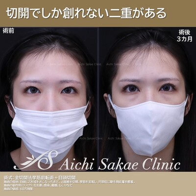切開でしかつくれない二重があるの症例写真