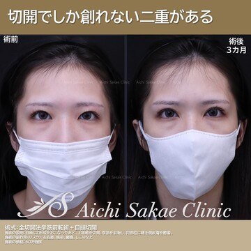 あいちビューティークリニック栄本院の目・二重整形の症例写真