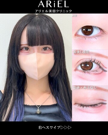 アリエル美容クリニック 大宮院の二重の症例写真