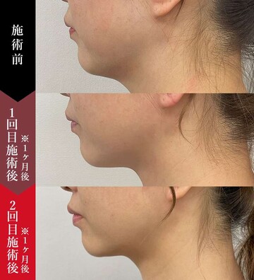 椿クリニックの輪郭・顎・エラ・額・小顔整形の症例写真