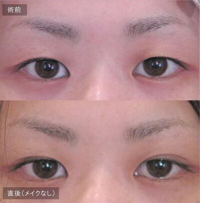 切らない二重手術 LS法ダブル (ロングプラン)の症例写真