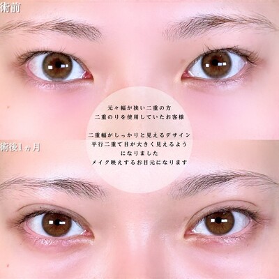 アリエルクイックループトリプルの症例写真