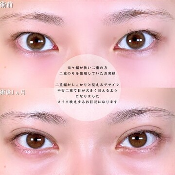 アリエル美容クリニック 大宮院の目・二重整形の症例写真