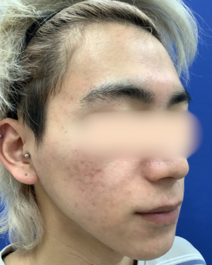 フェミークリニックのニキビ・ニキビ跡の治療の症例写真[ビフォー]