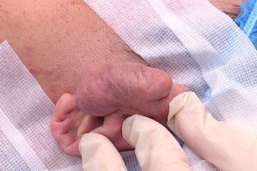 医療法人秀晄会 心斎橋コムロ美容外科クリニックの傷跡治療、ケロイドの症例写真[ビフォー]