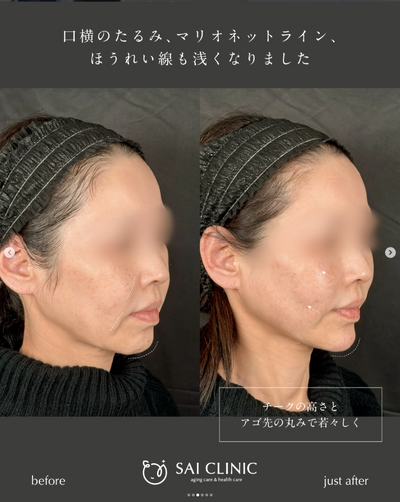 🪡糸リフト｜SAI LIFT STANDARD(18本)の症例写真