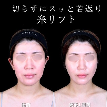 アリエル美容クリニック 大宮院のしわ・たるみ整形(注入、糸、フェイスリフト)の症例写真