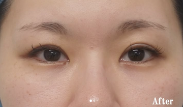 静岡美容外科橋本クリニックの症例写真[アフター]