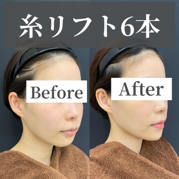CHARIS BEAUTY CLINICのしわ・たるみ整形(注入、糸、フェイスリフト)の症例写真
