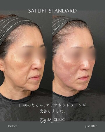 SAI CLINIC （サイクリニック）のリフトアップの症例写真
