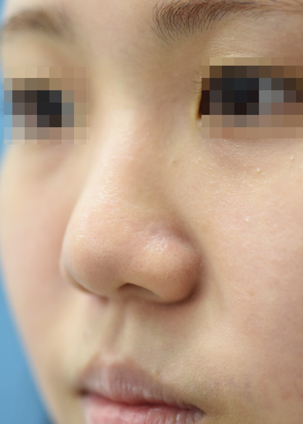 [20代 女性] 鼻プロテーゼと鼻中隔延長に於ける「魅せ鼻」整形（鼻の整形）の症例写真 (CS73657)｜みずほクリニック《美容医療の口コミ広場》